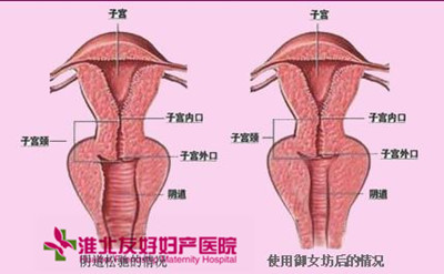宮頸肥大患者會有哪些典型癥狀